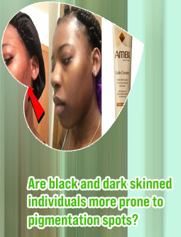 Dark spot remover for black skin